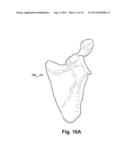 SYSTEM OF PREOPERATIVE PLANNING AND PROVISION OF PATIENT-SPECIFIC SURGICAL     AIDS diagram and image