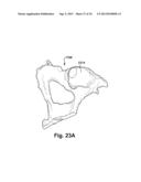 SYSTEM OF PREOPERATIVE PLANNING AND PROVISION OF PATIENT-SPECIFIC SURGICAL     AIDS diagram and image