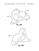 SYSTEM OF PREOPERATIVE PLANNING AND PROVISION OF PATIENT-SPECIFIC SURGICAL     AIDS diagram and image