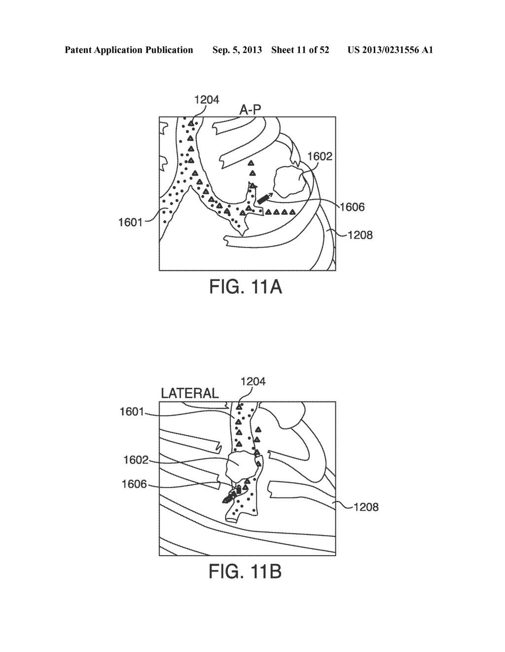SYSTEMS, METHODS AND DEVICES FOR PLACING A LOCALIZATION ELEMENT IN AN     ORGAN OF A PATIENT FOR FOUR DIMENSIONAL SOFT TISSUE NAVIGATION - diagram, schematic, and image 12