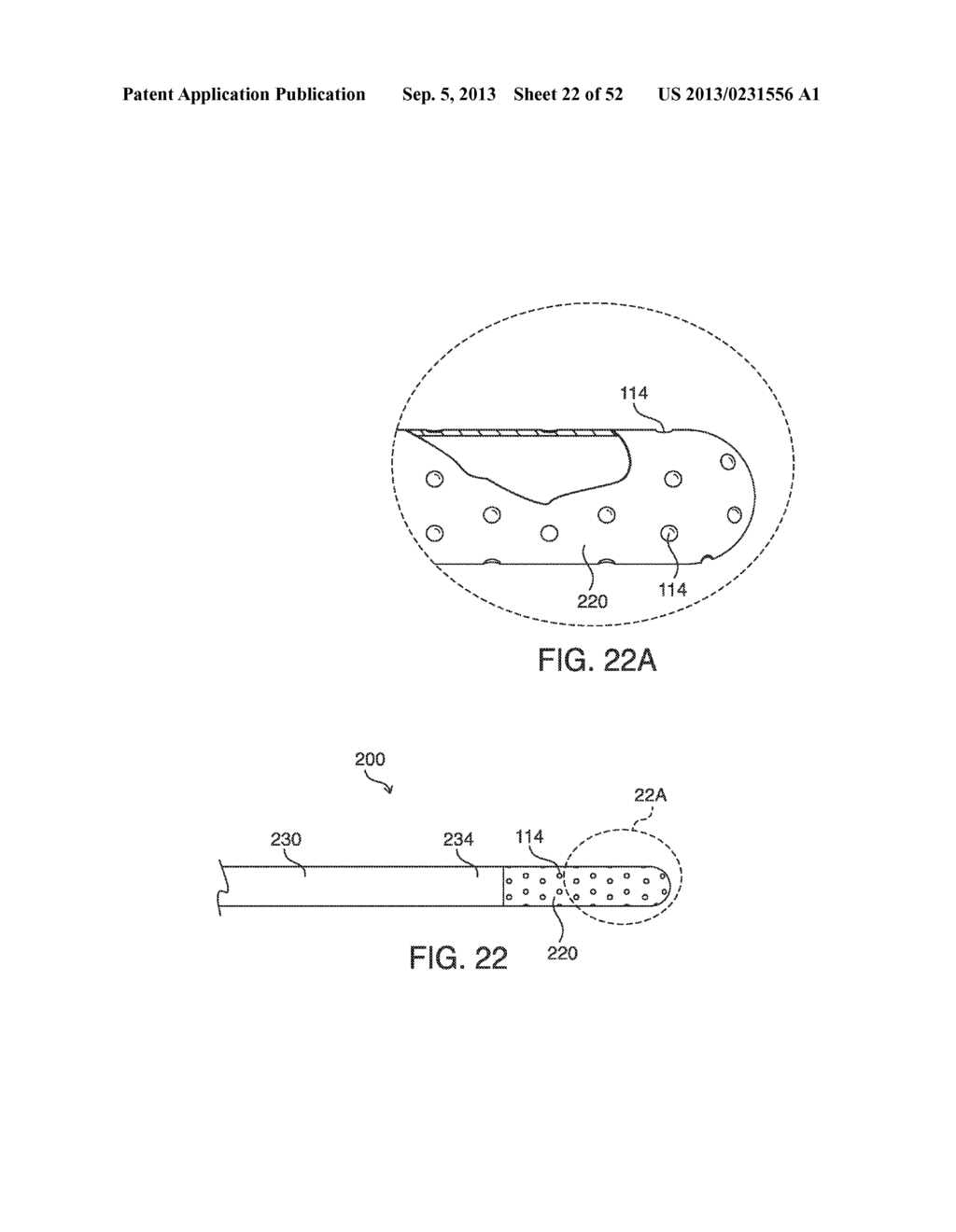 SYSTEMS, METHODS AND DEVICES FOR PLACING A LOCALIZATION ELEMENT IN AN     ORGAN OF A PATIENT FOR FOUR DIMENSIONAL SOFT TISSUE NAVIGATION - diagram, schematic, and image 23