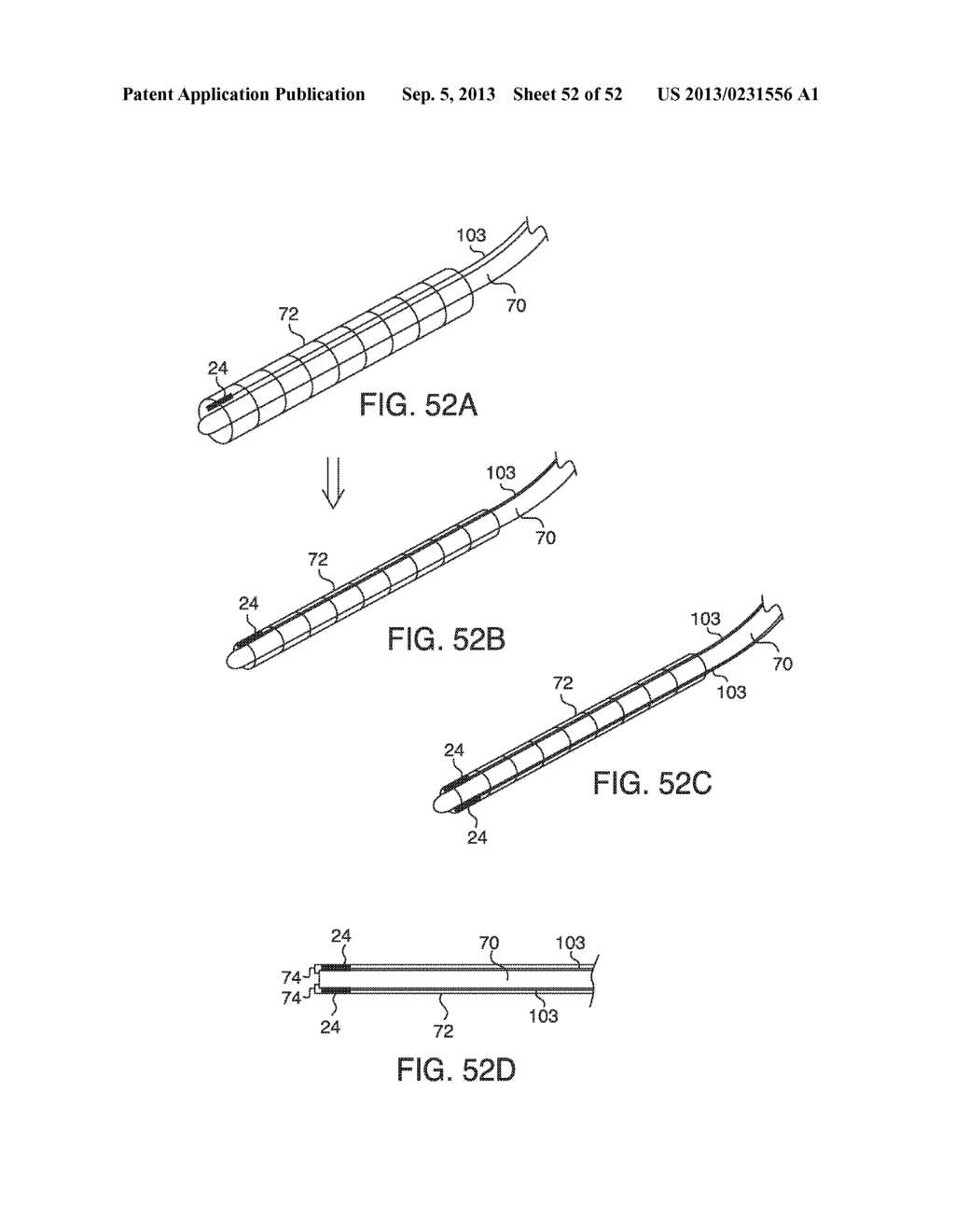 SYSTEMS, METHODS AND DEVICES FOR PLACING A LOCALIZATION ELEMENT IN AN     ORGAN OF A PATIENT FOR FOUR DIMENSIONAL SOFT TISSUE NAVIGATION - diagram, schematic, and image 53