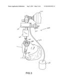 NON-INVASIVE SYSTEM TO REGULATE INTRACRANIAL PRESSURE diagram and image