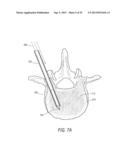 SYSTEM FOR USE IN TREATMENT OF VERTEBRAL FRACTURES diagram and image