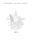 SYSTEM FOR USE IN TREATMENT OF VERTEBRAL FRACTURES diagram and image