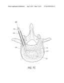 SYSTEM FOR USE IN TREATMENT OF VERTEBRAL FRACTURES diagram and image