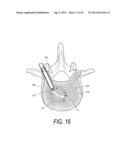 SYSTEM FOR USE IN TREATMENT OF VERTEBRAL FRACTURES diagram and image