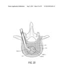 SYSTEM FOR USE IN TREATMENT OF VERTEBRAL FRACTURES diagram and image