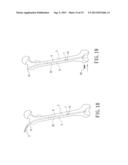 Support instrument with modular intramedullary nail diagram and image