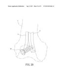 Support instrument with modular intramedullary nail diagram and image