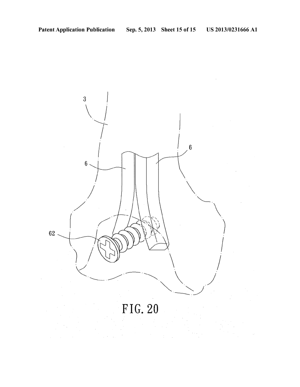 Support instrument with modular intramedullary nail - diagram, schematic, and image 16