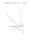 ORTHOPEDIC SUTURE PASSER AND METHOD diagram and image