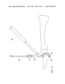 ORTHOPEDIC SUTURE PASSER AND METHOD diagram and image