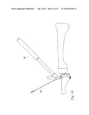 ORTHOPEDIC SUTURE PASSER AND METHOD diagram and image