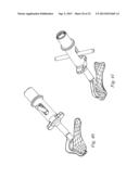 ORTHOPEDIC SUTURE PASSER AND METHOD diagram and image