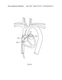 ROBOTIC CATHETER SYSTEM diagram and image