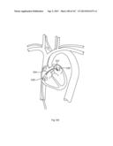 ROBOTIC CATHETER SYSTEM diagram and image