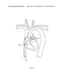 ROBOTIC CATHETER SYSTEM diagram and image