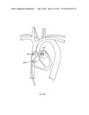 ROBOTIC CATHETER SYSTEM diagram and image