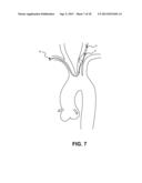 INTRAVASCULAR BLOOD FILTER diagram and image