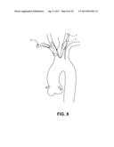 INTRAVASCULAR BLOOD FILTER diagram and image