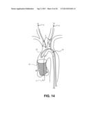 INTRAVASCULAR BLOOD FILTER diagram and image