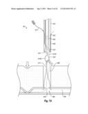 SUTURE SECURING SYSTEMS, DEVICES AND METHODS diagram and image