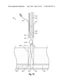 SUTURE SECURING SYSTEMS, DEVICES AND METHODS diagram and image