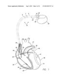 LEAD WITH BIOABSORBABLE METALLIC FIXATION STRUCTURE diagram and image