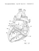 LEAD WITH BIOABSORBABLE METALLIC FIXATION STRUCTURE diagram and image