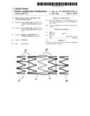 Implantable Graft Assembly and Aneurysm Treatment diagram and image