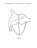 INTRA-ATRIAL IMPLANTS MADE OF NON-BRAIDED MATERIAL diagram and image