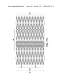 INTRA-ATRIAL IMPLANTS MADE OF NON-BRAIDED MATERIAL diagram and image