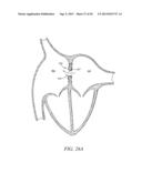 INTRA-ATRIAL IMPLANTS MADE OF NON-BRAIDED MATERIAL diagram and image