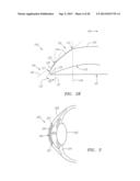 Small Diameter Corneal Inlays diagram and image