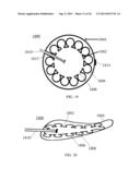 HYBRID BREAST IMPLANT diagram and image