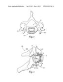 INTERBODY DEVICE AND PLATE FOR SPINAL STABILIZATION AND INSTRUMENTS FOR     POSITIONING SAME diagram and image