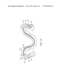 DENTAL BONE CONDUCTION HEARING APPLIANCE diagram and image