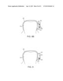 DENTAL BONE CONDUCTION HEARING APPLIANCE diagram and image