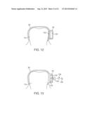 DENTAL BONE CONDUCTION HEARING APPLIANCE diagram and image