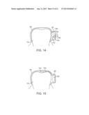 DENTAL BONE CONDUCTION HEARING APPLIANCE diagram and image