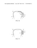 DENTAL BONE CONDUCTION HEARING APPLIANCE diagram and image