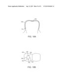 DENTAL BONE CONDUCTION HEARING APPLIANCE diagram and image