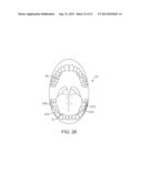 DENTAL BONE CONDUCTION HEARING APPLIANCE diagram and image