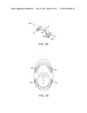 DENTAL BONE CONDUCTION HEARING APPLIANCE diagram and image