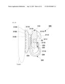 SELF-LIGATION ORTHODONTIC BRACKET diagram and image