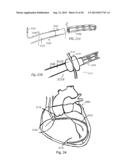 DEVICES AND METHODS FOR ASSISTING CARDIAC FUNCTION diagram and image