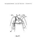 DEVICES AND METHODS FOR ASSISTING CARDIAC FUNCTION diagram and image