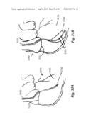 DEVICES AND METHODS FOR ASSISTING CARDIAC FUNCTION diagram and image