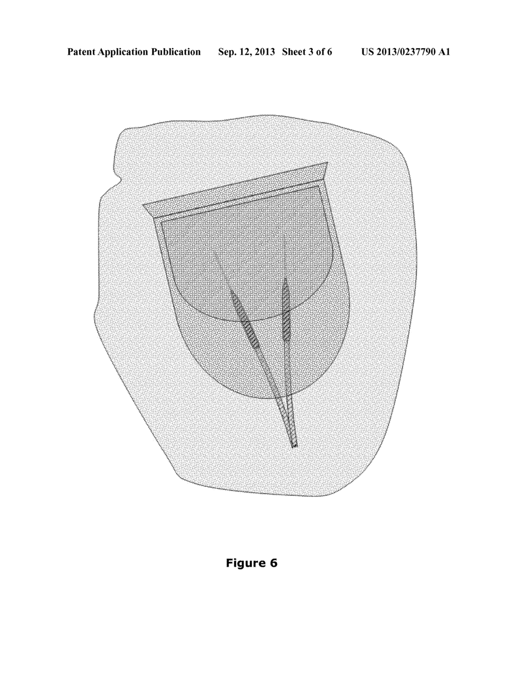 Method and devices for its employ for reducing disease-transfer risks - diagram, schematic, and image 04